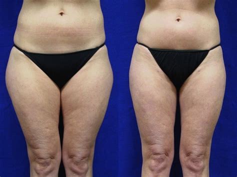 These 20 before and after photos may just surprise you. Liposuction should complement a woman's body proportions ...