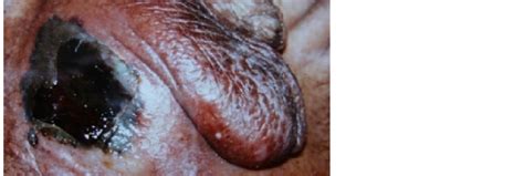 It is primarily a clinical diagnosis. Fournier's Gangrene: Analysis of 14 Cases