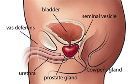 The symptoms of advanced prostate cancer depend on where the cancer has spread to. Prostate Cancer | ByHealth.com