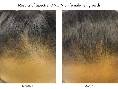 Adenosine is useful for treating female pattern hair loss in women as well as androgenetic alopecia in men. Nanoxidil lotion: Spectral DNC-N - Hair Growth Specialist