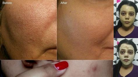 This inexpensive and highly effective remedy for how to get rid of clogged pores can open and wash away all kinds of impurities trapped inside the. How to get Rid of Open Pores or Large Pores or Clogged ...