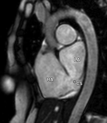 Anatomy atlas of the coronary arteries in interventional radiology: Imaging of the Coronary Sinus: Normal Anatomy and ...