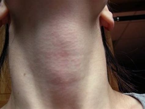 The neck is the part of the body on many vertebrates that connects the head with the torso and provides the mobility and movements of the head. Itchy neck - Pictures, Symptoms, Treatment, Rash, Causes - (2020 - Updated)