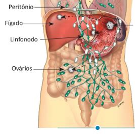 Obstrução mecânica do intestino delgado as causas comuns da obstrução mecânica, em que algo bloqueia fisicamente o intestino delgado, incluem: Obstrução Intestinal em Pacientes Oncológicos - Blog do ...