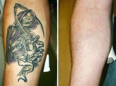 But can tattoos be removed completely? Laser Tattoo Removal in Delhi