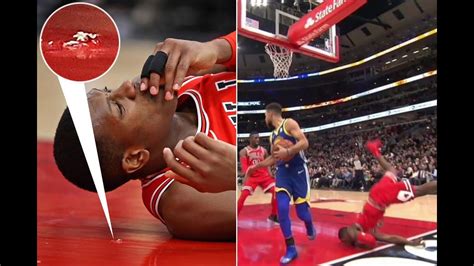 There was a good little chunk that he took out of. Chicago Bulls star Kris Dunn chips tooth after face ...