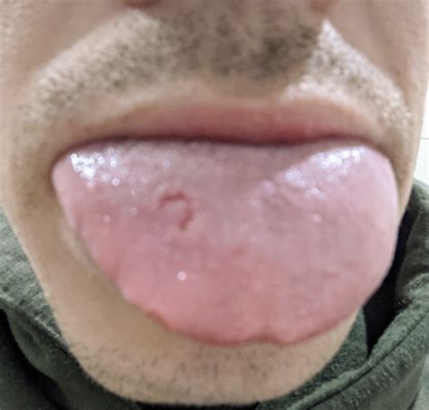 Recurring Tongue problem | Oral and Dental Problems | Forums | Patient