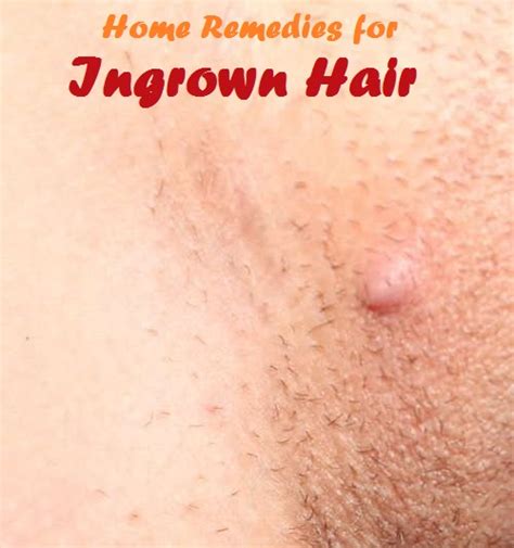 It is caused by an infection of the hair follicles, this is by a bacteria staphylococcus aureus. Home Remedies for Ingrown Hair | BEAUTY ENHANCERS