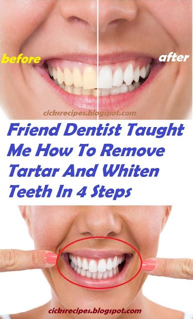 Removing plaque from your teeth daily is crucial to avoid tartar buildup & further issues. A Friend Dentist Taught Me How To Remove Tartar And Whiten ...