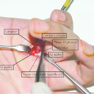Injuries to the flexor tendons of the hand are common. (PDF) Ganglion of the Flexor Tendon Sheath between A1 ...