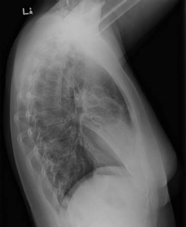 Limb amputation alters body image and changes the client's adls, work, and recreational activities, which triggers a grieving process for the client. Chest (lateral view) | Radiology Reference Article ...