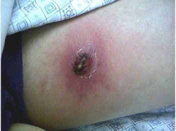 Symptoms of a brown recluse spider bite are a mild sting followed by severe pain and local redness that usually develops within. Spider Bites - Injuries; Poisoning - Merck Manuals ...