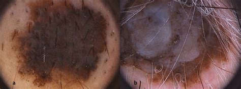 Melanoma can also appear in your eyes, but it's exceptionally rare. Melanoma of the face/scalp: a) the homogeneous-globular ...