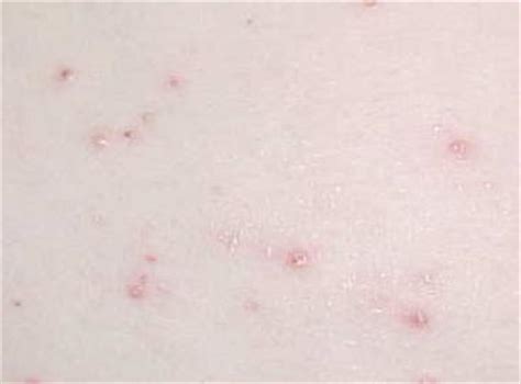 Molluscum contagiosum is a common, yet rarely discussed skin infection. Genital warts, Anal wart, Molluscum contagiosum removing ...