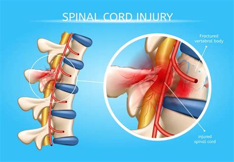 The spinal cord carries messages and instructions from the brain to. Symptoms and Treatment for a Spinal Cord Injury - Zervos ...