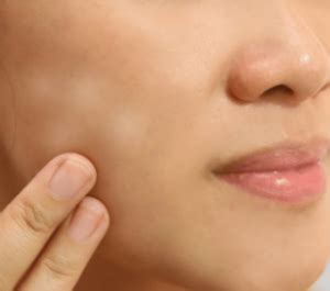 White spots on face causes medical treatment and home remedies top 10 home remedies. White Spots on Face Causes: of Child, Small, Patches ...