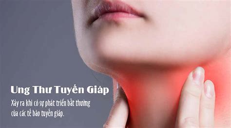 Tổng quan bệnh ung thư tuyến giáp. Ung Thư Tuyến Giáp