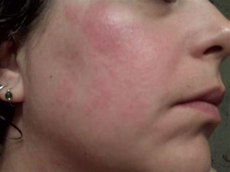 Prickly heat causes, symptoms, diagnosis and treatment. Heat Rash ?? | V-Lo's View