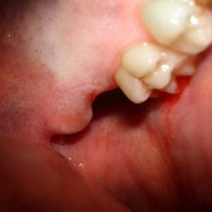 You can chew more, but to be on the safe side, avoid chewing on the side of your mouth that the surgery is on. Soft foods after tooth extraction | General center ...