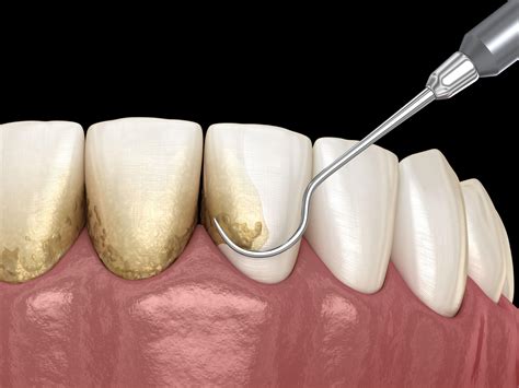 Yes its a bad idea. How to Remove Tartar from Teeth Without a Dentist ...