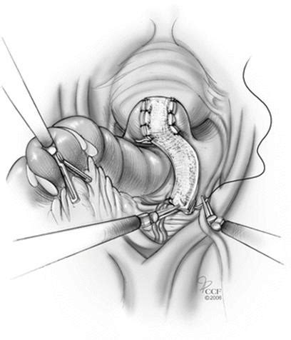 Pelvic anatomy mri variant anatomy pelvic viscera. Laparoscopic and Robotic Assisted Laparoscopic ...