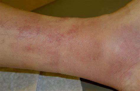 Тромбофлебит нижних конечностей диета Методы лечения тромбофлебита и его профилактика Методы лечения тромбофлебита и его профилактика Тромбофлебит нижних конечностей диета