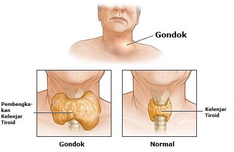 Penyebab penyakit tiroid yang terakhir adalah adanya intervensi dari penyakit tertentu (komplikasi). bahaya kelenjar tiroid: Ciri-ciri dari penyakit kelenjar ...