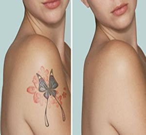 It all depends on the tattoo itself your skin the healing process and how you take care of it. Saline Pigment (tattoo) Removal - Invigorate Spa