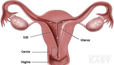 Jan 25, 2021 · your iud can protect you against unwanted pregnancy for up to ten years, depending on the device you have. PsychoSocioSexuality: June 2014