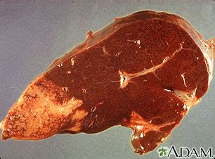 O câncer linfático corresponde a uma alteração nas células de defesa do organismo, os linfócitos, que passam a proliferar rapidamente, podendo resultar na formação de um tumor. Linfoma de Hodgkin: MedlinePlus enciclopedia médica