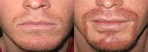 If you go to the right. Beard Transplant FUE in Latvia | Aesthetic surgery and ...