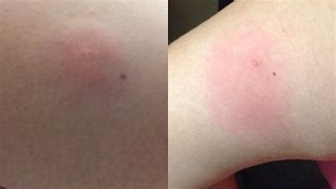 The bites typically leave small red bumps that cause they feed on plants and trees, causing damage and sometimes death to the food source. Mite Bites A Growing Problem in Oklahoma This Fall | KTUL