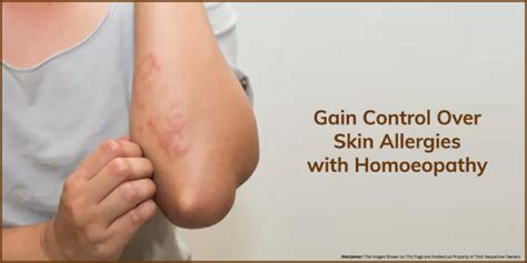 Dr positive homeopathy offers homeopathy medicine for allergy. Homeopathy Treatment for Skin Allergies | Dr. Mahavrat Patel