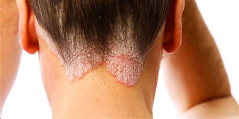 In eczema, there is inflammation of the thick layer of the skin called dermis. Ekzeme : Diagnostik- und Therapiemethoden