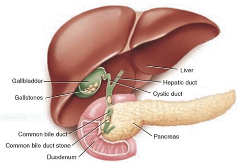 Is it an acronym, and how did it originate? Cholelithiasis-and-Choledocholithiasis-1A - Medical ...