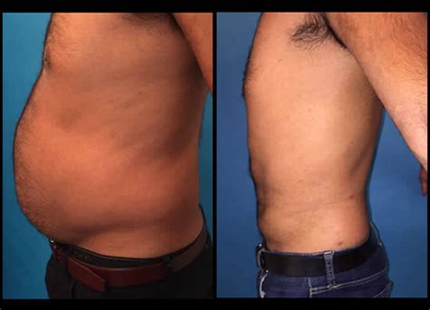 Get into position by standing up or leaning against stop right before the glans: Liposuction Before And After NYC | Liposuction Results