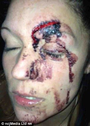 Mothers suffer horrific injuries when heads were smashed together in ...