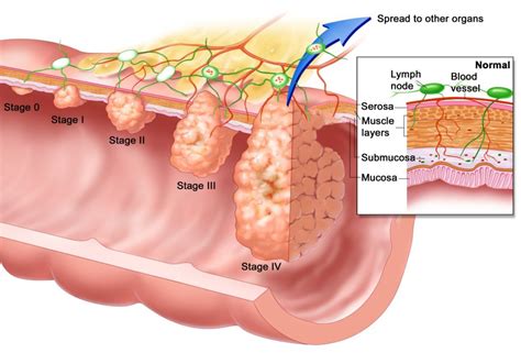 Blue, marigold, and purple awareness month: Hemorrhoids or Colon Cancer | Health Care «Qsota»