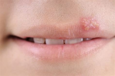 Es gibt arten, die äußerlich wie innerlich nutzbar sind, andere wiederum sollten nur äußerlich benutzt werden. Lippenherpes innerlich behandeln - experto.de