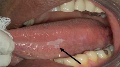 Throat cancer is very common in people habituated to unhealthy lifestyles and addictive habits. Mouth Cancer Black Spot Inside Cheek - CancerWalls