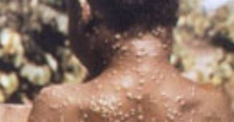 This is followed by a rash that forms blisters and crusts over. Outbreaks of monkeypox and drug-resistant TB in UK ...