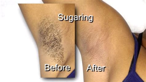 Once you've cleaned the razor, pour a little rubbing alcohol over the top of the blades to kill any bacteria. Female Hair Removal - Underarm Sugaring With Sugar Wax In ...