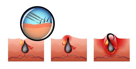 When there is recurrence of ingrown hair, inflammation can occur in that area and present as redness of the surface of the skin and a chronic recurrence of itchy buttons. How to Get Rid of Ingrown Hair | Women's Alphabet