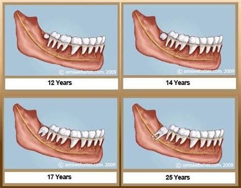 Wisdom teeth usually come in between the ages of 17 and 21 years old. Pin on Wisdom Teeth