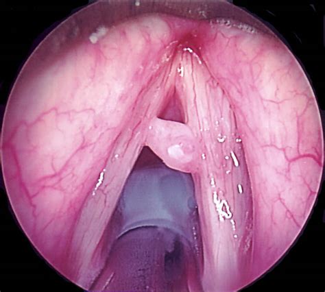 Vocale anatomie exprimer voix énoncer larynx gorge goulot kyste désordre trouble laryngien laryngique laryngé laryngoscopy polype respiratoire système anatomique biologie expirer inspirer respire respirer. Фиброма гортани: причины, симптомы, диагностика и лечение