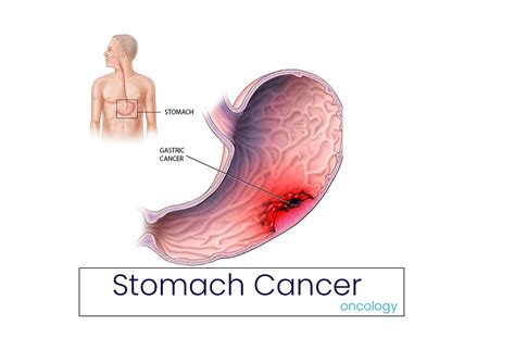 Or, the cause may be a different medical condition that is not cancer. Stomach Cancer: Causes, Symptoms, Staging, Diagnosis and ...