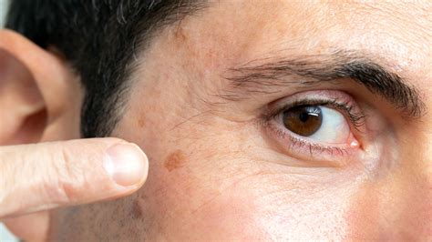 Melanoma (also called malignant melanoma) is a cancer that usually starts in the skin. If You Have Skin Cancer on the Face, Scalp or Ears, this ...