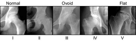 Perthes disease is a rare kind of disability, primarily affecting the hip joint of children. Perthes behöver inte stå i vägen för ytersättning, fråga ...