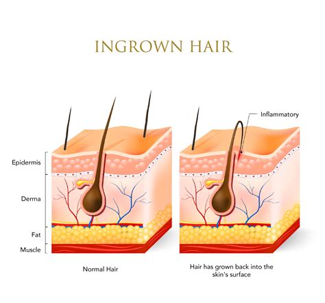 Take caution and never try to pull out the hairs using a pair of tweezers. How to Prevent Ingrown Hairs - ORO GOLD School