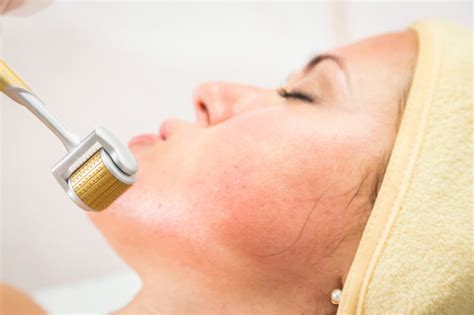 Thicker skin (such as mature skin, stretch marks, scar tissue) may require a slightly deeper microneedling depth for optimal results. Shedding Microneedling : Hair Shedding Scale Scores Vary ...